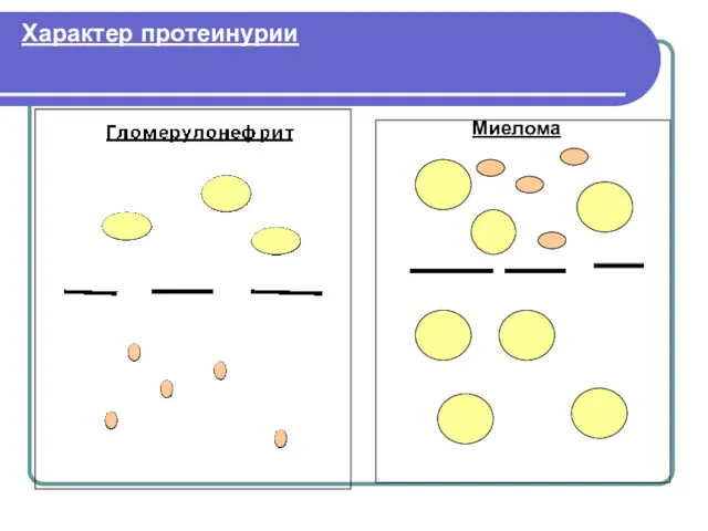 Характер протеинурии Миелома