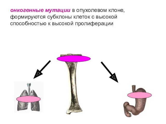 онкогенные мутации в опухолевом клоне, формируются субклоны клеток с высокой способностью к высокой пролиферации