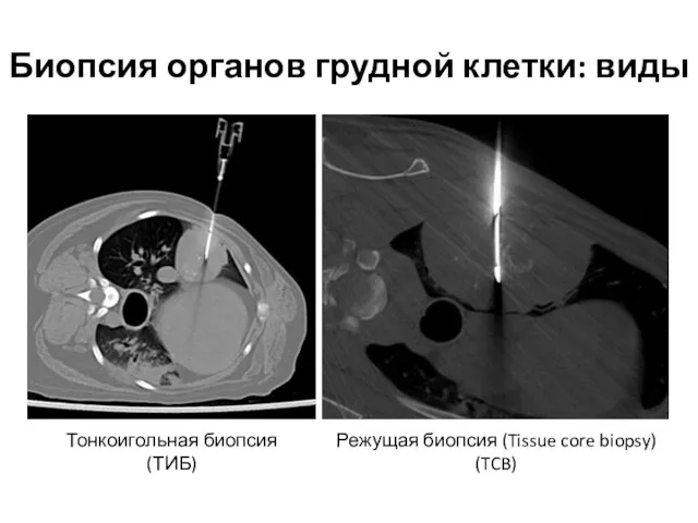 Биопсия органов грудной клетки: виды Тонкоигольная биопсия (ТИБ) Режущая биопсия (Tissue core biopsy) (TCB)