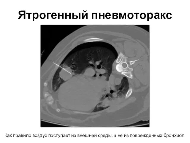 Ятрогенный пневмоторакс Как правило воздух поступает из внешней среды, а не из поврежденных бронхиол.