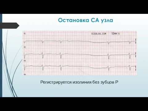 Остановка СА узла Регистрируется изолиния без зубцов Р