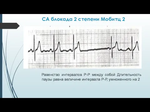 СА блокада 2 степени Мобитц 2 Равенство интервалов Р-Р между