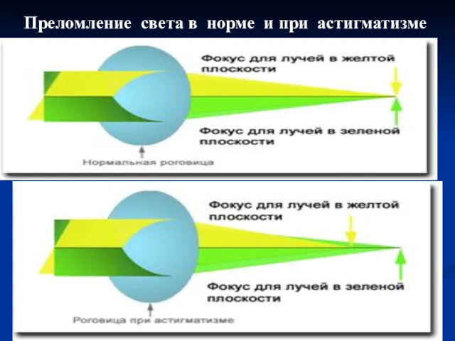 Преломление света в норме и при астигматизме