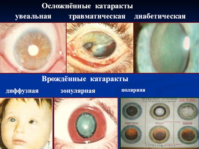 Осложнённые катаракты увеальная травматическая диабетическая Врождённые катаракты диффузная зонулярная полярная