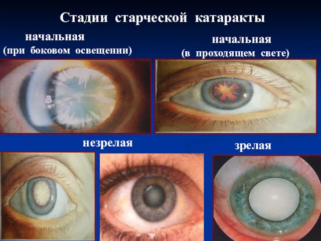 Стадии старческой катаракты начальная (при боковом освещении) начальная (в проходящем свете) незрелая зрелая