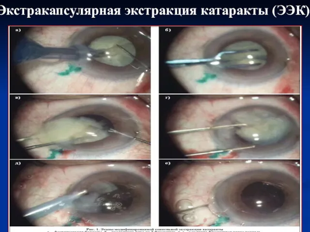 Экстракапсулярная экстракция катаракты (ЭЭК)
