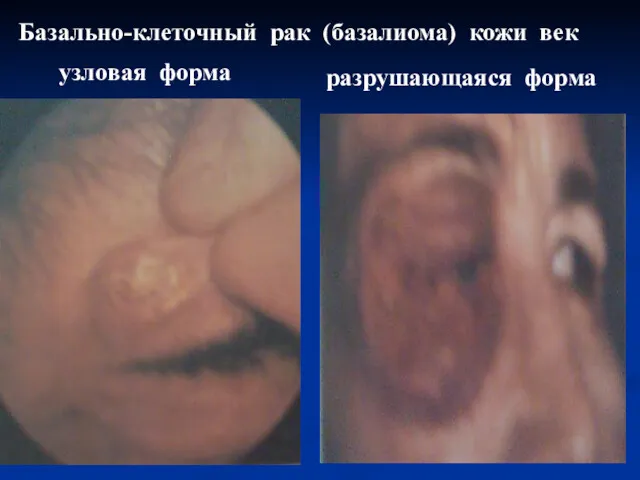 Базально-клеточный рак (базалиома) кожи век узловая форма разрушающаяся форма