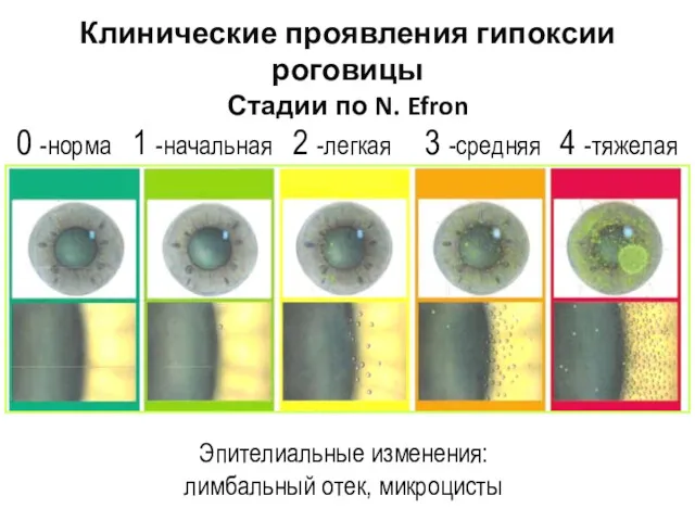 Клинические проявления гипоксии роговицы Стадии по N. Efron 0 -норма