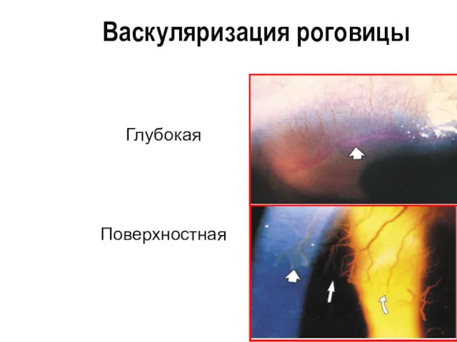 Васкуляризация роговицы Глубокая Поверхностная