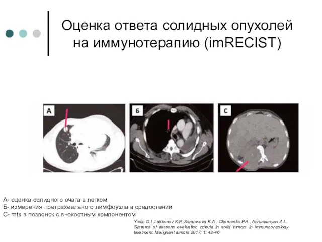 Оценка ответа солидных опухолей на иммунотерапию (imRECIST) А- оценка солидного