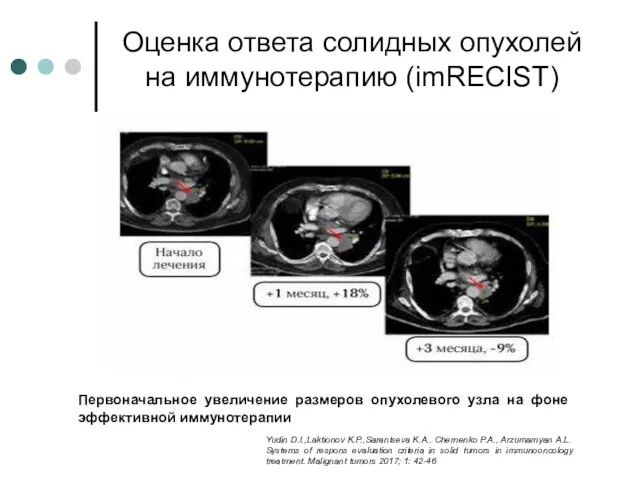 Оценка ответа солидных опухолей на иммунотерапию (imRECIST) Первоначальное увеличение размеров