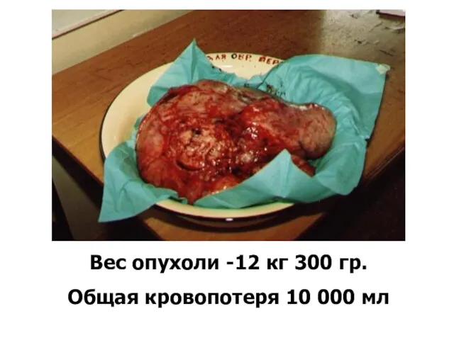 Вес опухоли -12 кг 300 гр. Общая кровопотеря 10 000 мл