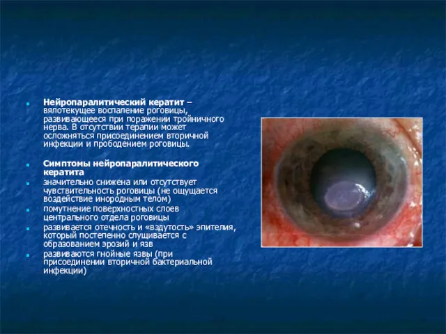 Нейропаралитический кератит – вялотекущее воспаление роговицы, развивающееся при поражении тройничного