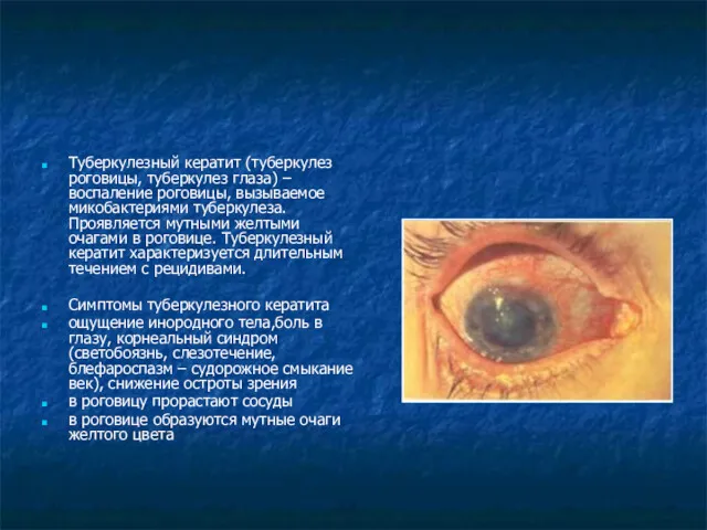 Туберкулезный кератит (туберкулез роговицы, туберкулез глаза) – воспаление роговицы, вызываемое