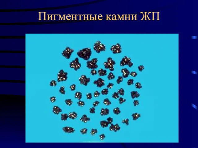 Пигментные камни ЖП