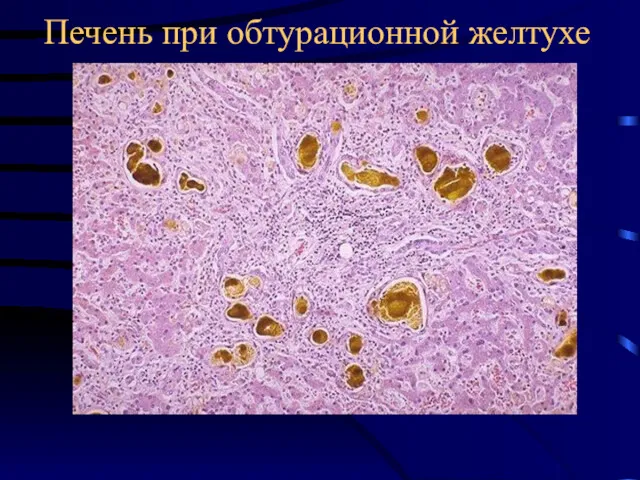 Печень при обтурационной желтухе