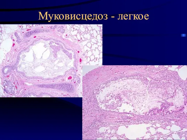 Муковисцедоз - легкое