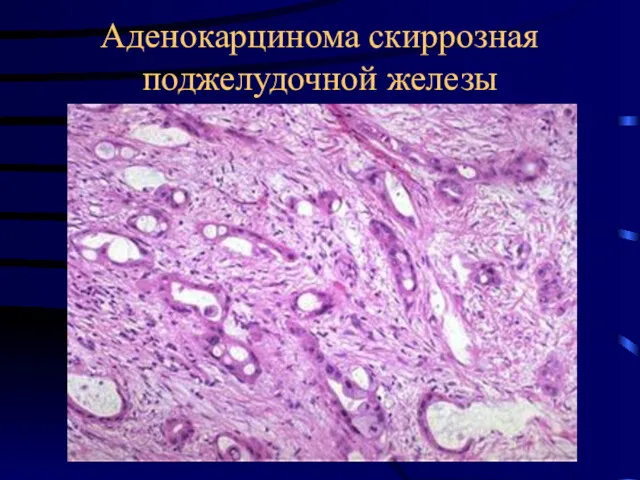 Аденокарцинома скиррозная поджелудочной железы