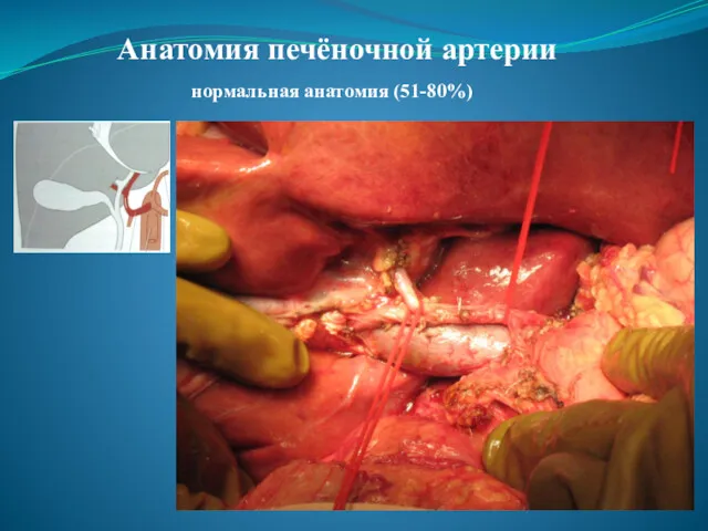 Анатомия печёночной артерии нормальная анатомия (51-80%)