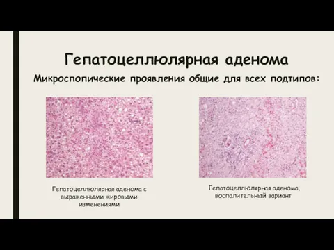Гепатоцеллюлярная аденома Микроспопические проявления общие для всех подтипов: Гепатоцеллюлярная аденома