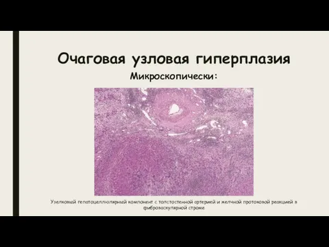 Очаговая узловая гиперплазия Микроскопически: Узелковый гепатоцеллюлярный компонент с толстостенной артерией