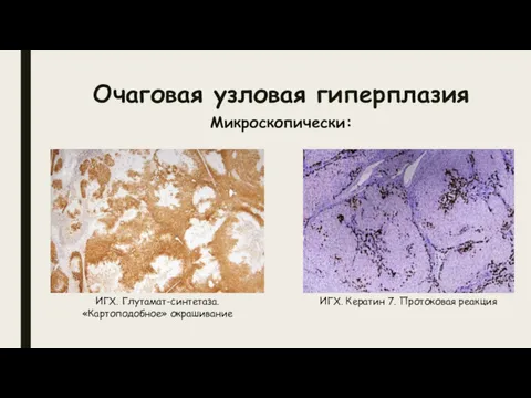 Очаговая узловая гиперплазия Микроскопически: ИГХ. Глутамат-синтетаза. «Картоподобное» окрашивание ИГХ. Кератин 7. Протоковая реакция