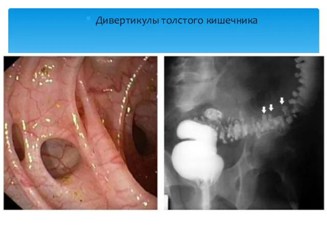 Дивертикулы толстого кишечника