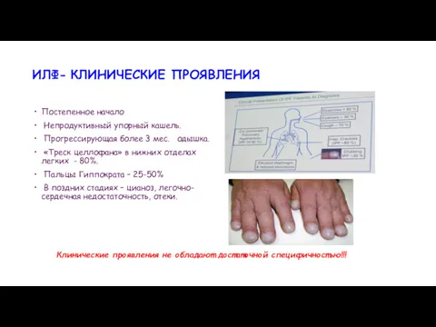 Постепенное начало Непродуктивный упорный кашель. Прогрессирующая более 3 мес. одышка.