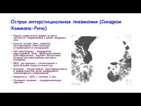 Острая интерстициальная пневмония (Синдром Хаммана-Рича) Редкая скоротечная форма острого легочного