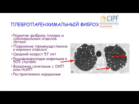 ПЛЕВРОПАРЕНХИМАЛЬНЫЙ ФИБРОЭЛАСТОЗ Развитие фиброза плевры и сублевральных отделов легких Поражение