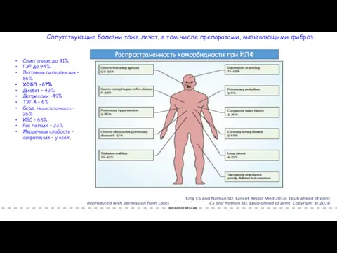 Распространенность коморбидности при ИЛФ Слип апное до 91% ГЭР до