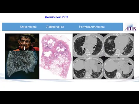 Диагностика ИЛФ Клиническая Лабораторная Рентгенологическая
