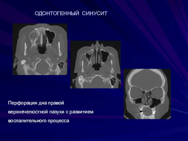 Перфорация дна правой верхнечелюстной пазухи с развитием воспалительного процесса ОДОНТОГЕННЫЙ СИНУСИТ