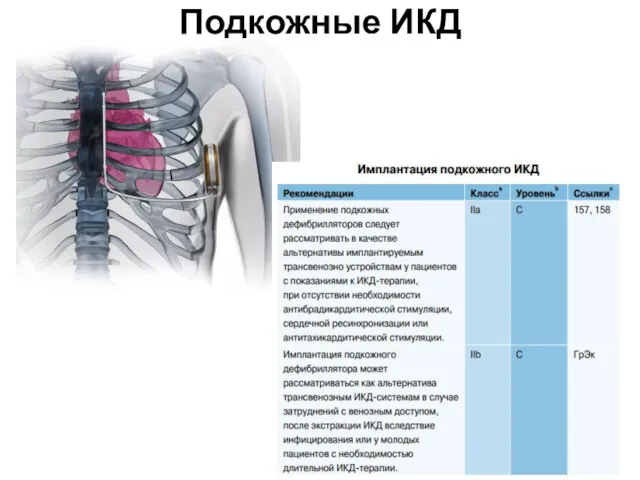 Подкожные ИКД