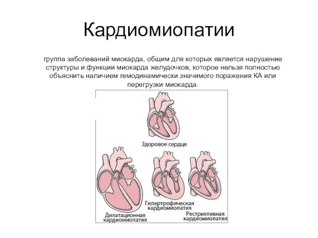 Кардиомиопатии группа заболеваний миокарда, общим для которых является нарушение структуры