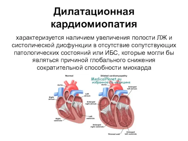 Дилатационная кардиомиопатия характеризуется наличием увеличения полости ЛЖ и систолической дисфункции