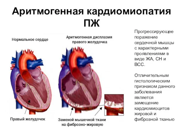 Аритмогенная кардиомиопатия ПЖ Прогрессирующее поражение сердечной мышцы с характерными проявлениями