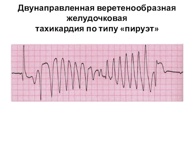 Двунаправленная веретенообразная желудочковая тахикардия по типу «пируэт»