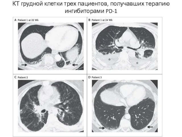 КТ грудной клетки трех пациентов, получавших терапию ингибиторами PD-1