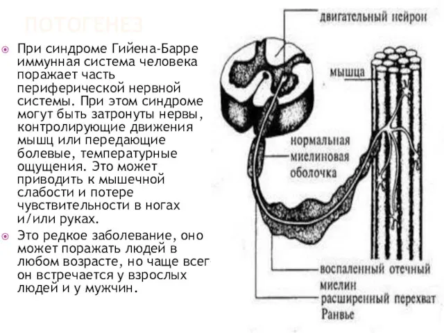 ПОТОГЕНЕЗ При синдроме Гийена-Барре иммунная система человека поражает часть периферической