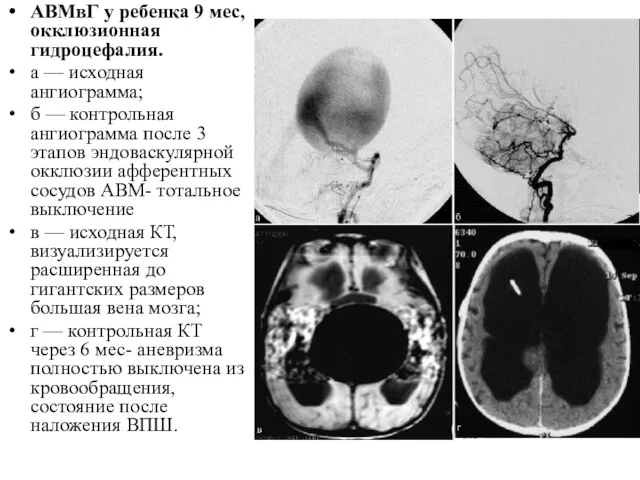 АВМвГ у ребенка 9 мес, окклюзионная гидроцефалия. а — исходная