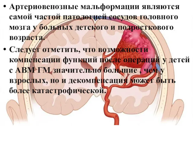 Артериовенозные мальформации являются самой частой патологией сосудов головного мозга у