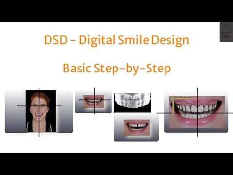 DSD - Digital Smile Design Basic Step-by-Step