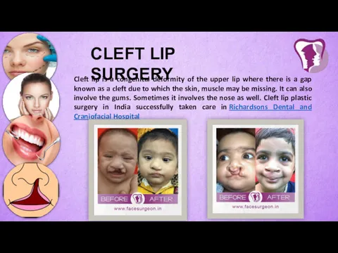 CLEFT LIP SURGERY Cleft lip is a congenital deformity of the upper lip