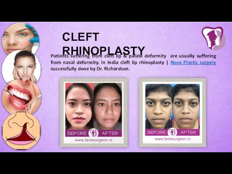CLEFT RHINOPLASTY Patients suffering from cleft lip & palate deformity are usually suffering