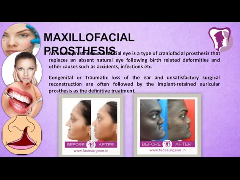 MAXILLOFACIAL PROSTHESIS An ocular prosthesis or artificial eye is a