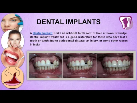 DENTAL IMPLANTS A Dental Implant is like an artificial tooth root to hold