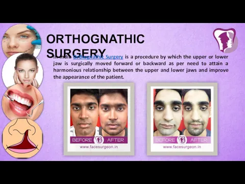 ORTHOGNATHIC SURGERY In India Orthognathic Surgery is a procedure by