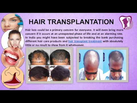 HAIR TRANSPLANTATION Hair loss could be a primary concern for