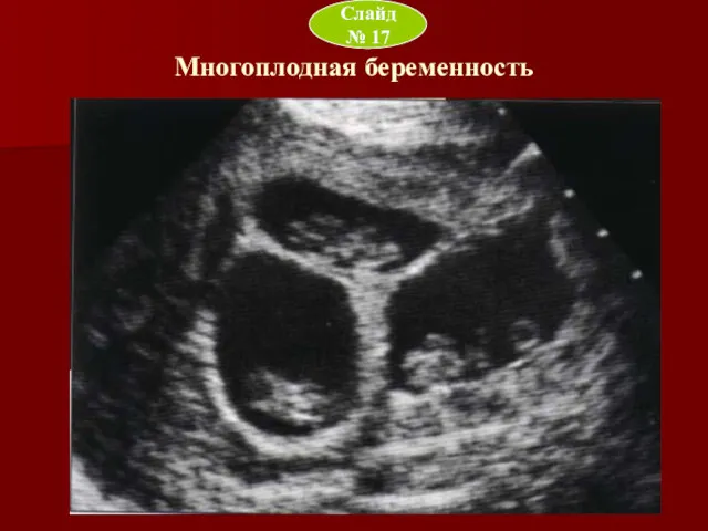Многоплодная беременность Слайд № 17